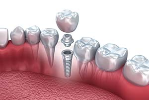 bvn564fg Dental Implants Aftercare: How to Extend the Life of Your Replacement Tooth