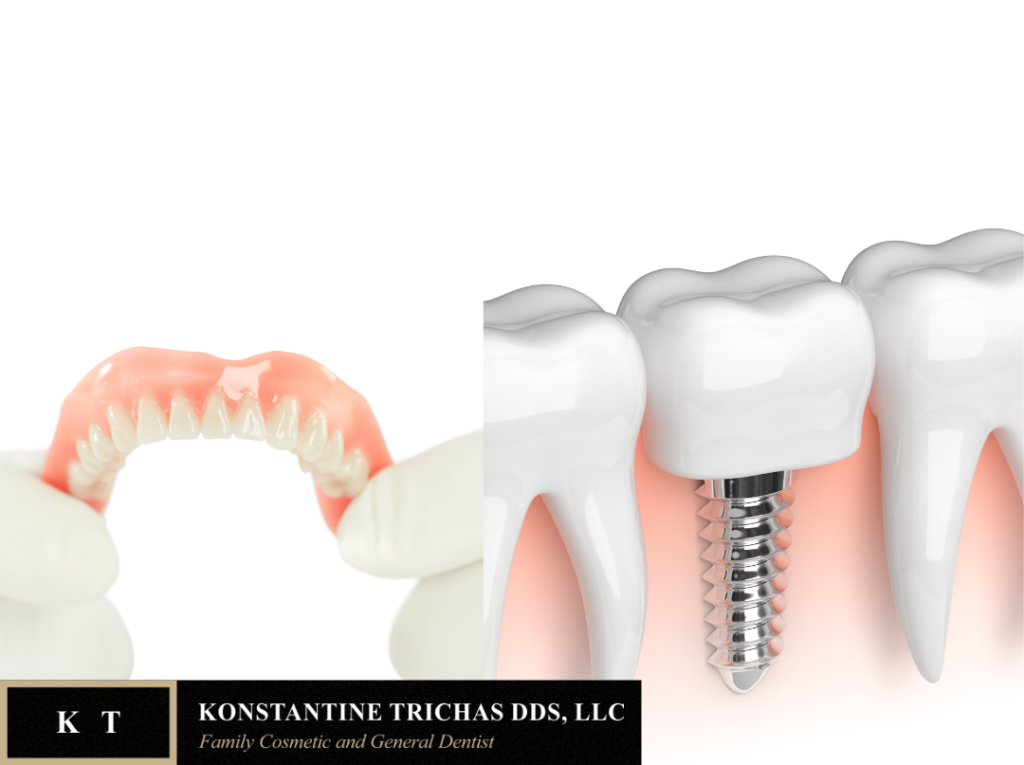 Dental Implants vs Dentures