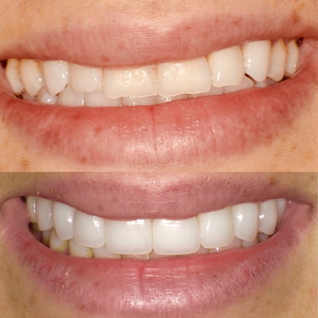 A Beautiful Smile Makeover 